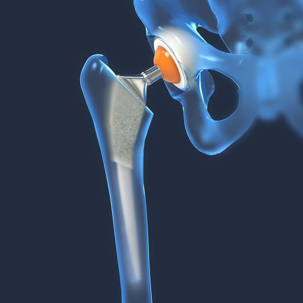 hip replacement