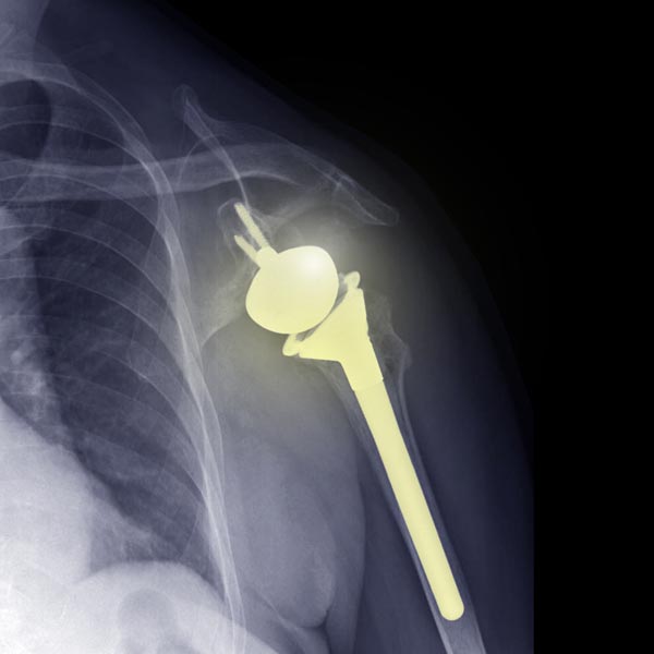 x-ray showing medical device in shoulder