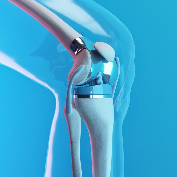 knee replacement device