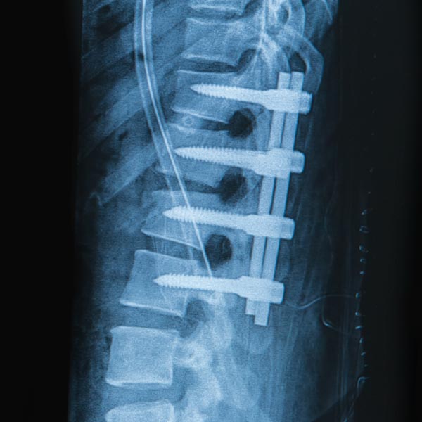 x-ray of screws in spine